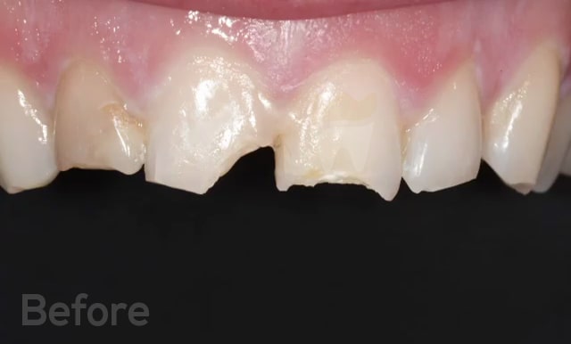 Crooked Teeth