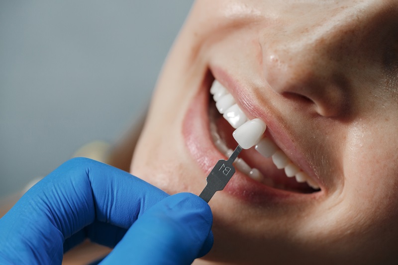 Are You an Ideal Candidate for Cosmetic Dental Veneers?