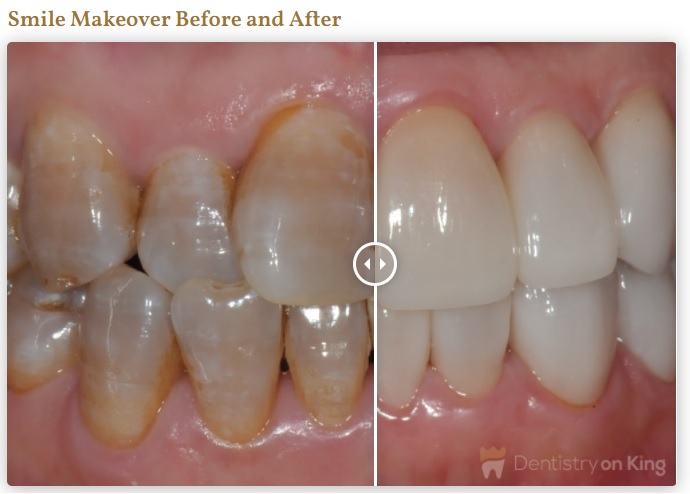 wedding smile makeover before after photos