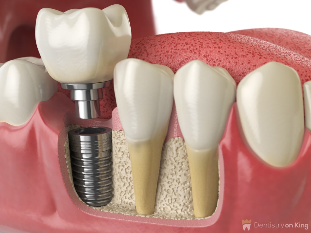 Dental Implant Toronto