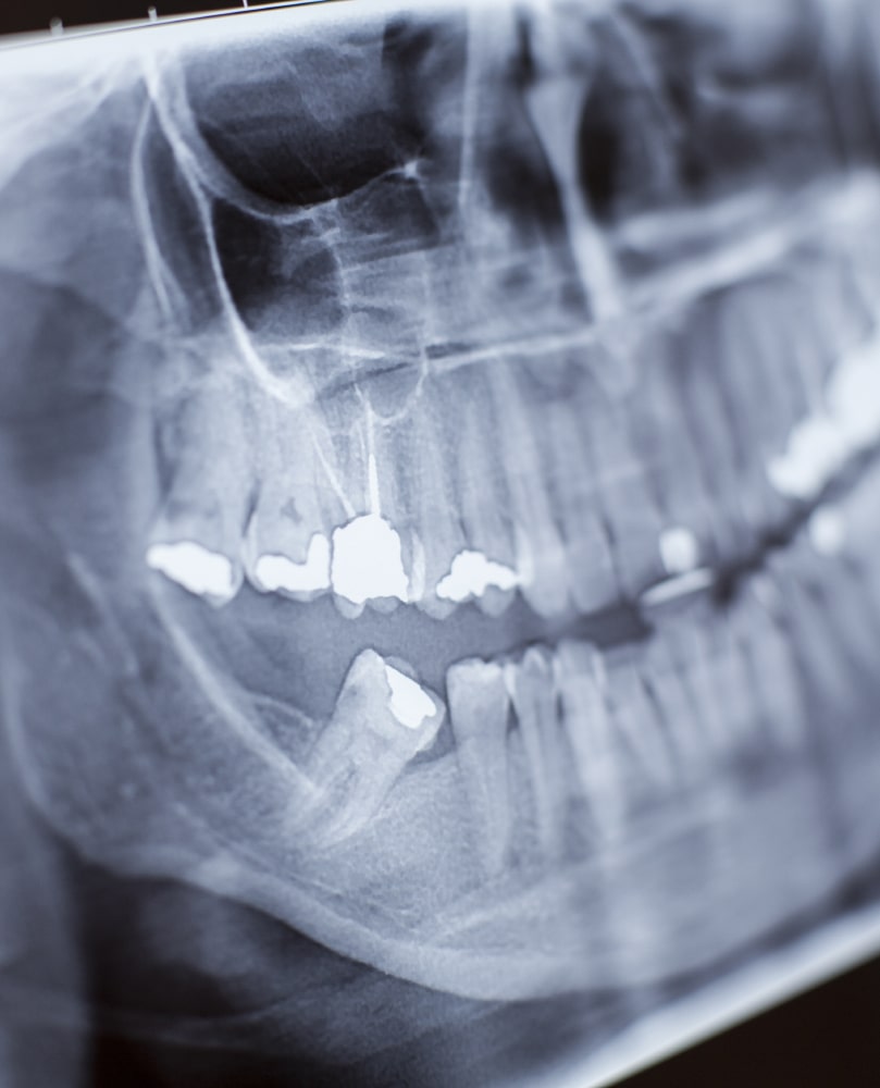Wisdom Tooth Extraction Toronto