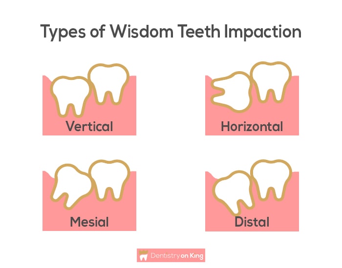 Types of Wisdom Teeth Impaction shown using graphics