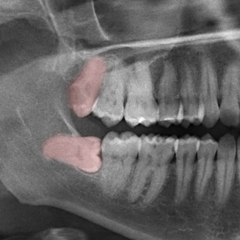 Wisdom Teeth Removal in Toronto at Dentistry on King by Dr. Mahan Alavi