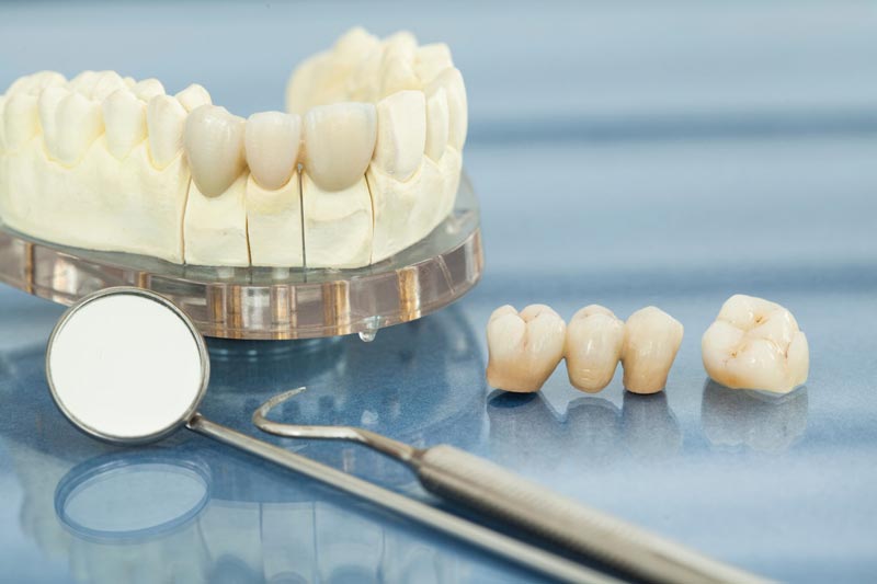 dental crowns toronto