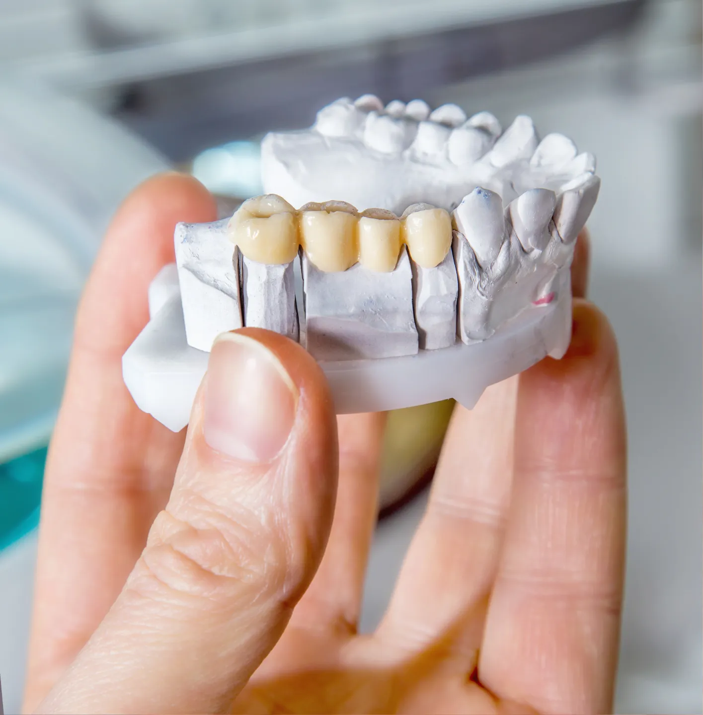 Hand holding a dental model with a four-tooth bridge prosthesis.