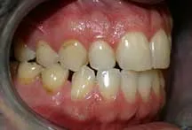 ground-teeth-closed