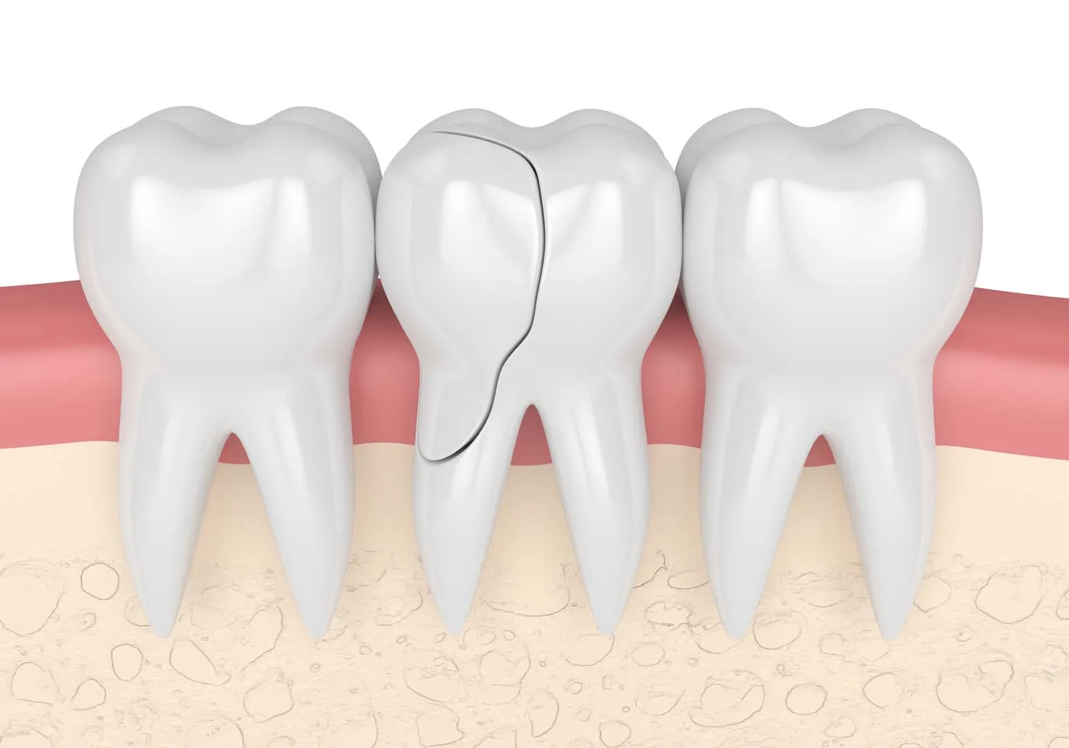 How To Prevent Crooked Teeth