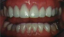 After Cosmetic Dentistry