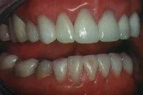 Right Side: After