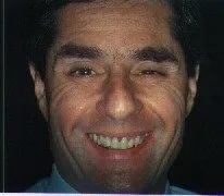 Before Treatment