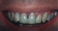 Before Treatment Smile
