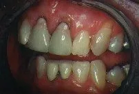 Left Side: Before