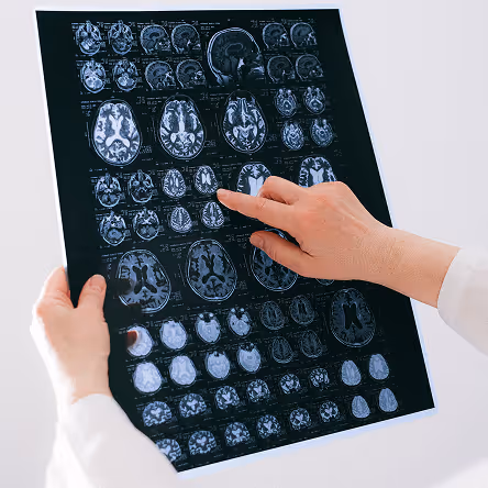 Hands holding and pointing to a black and white brain MRI scan film with multiple brain images.