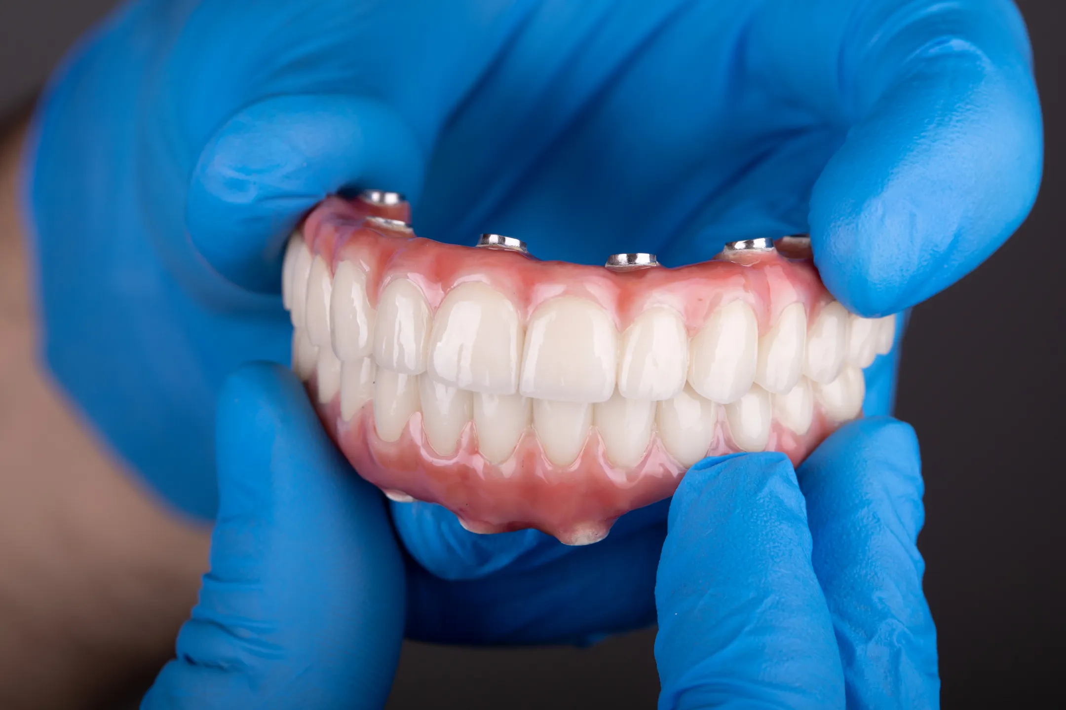 Implant-Supported Dentures
