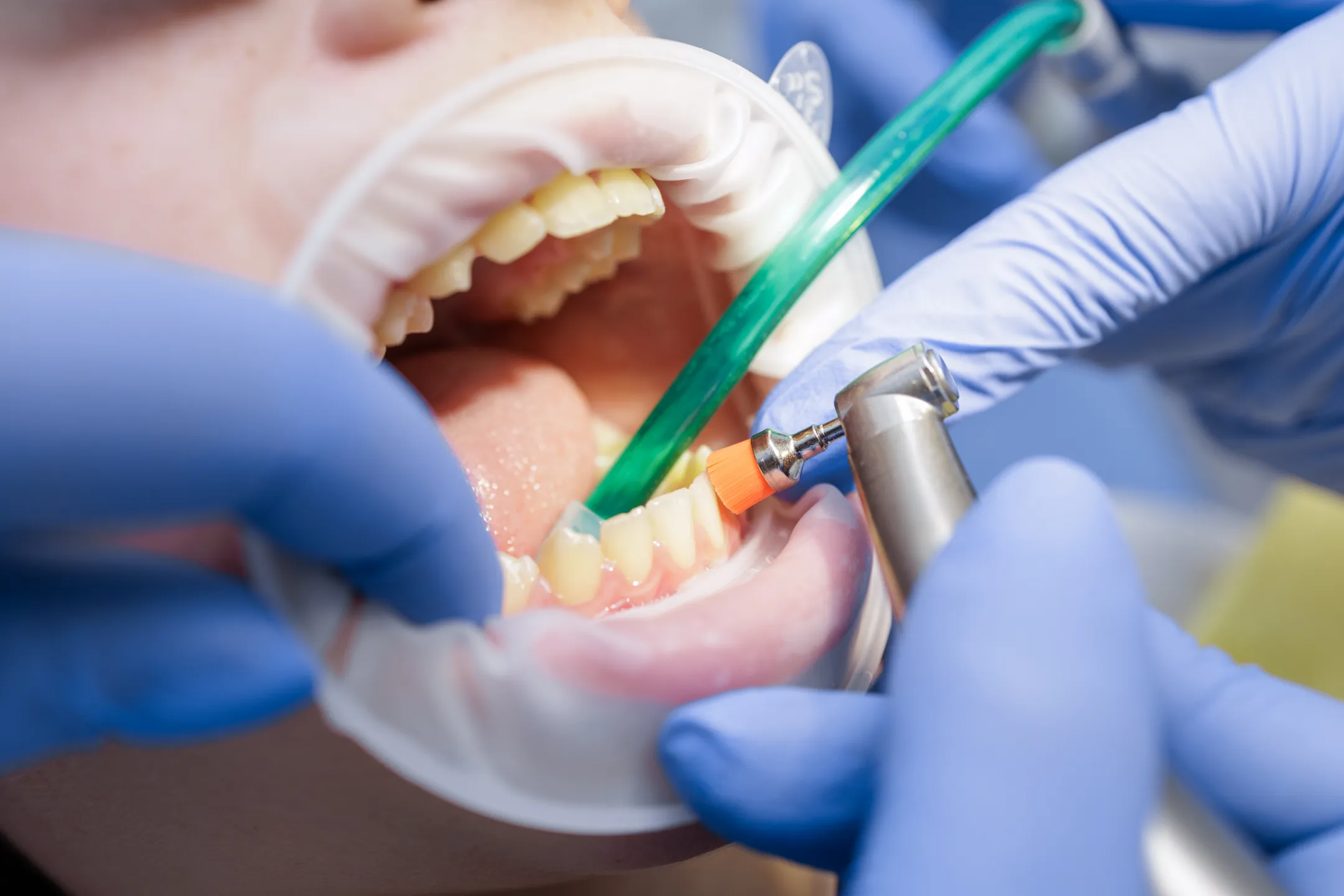 Fluoride Treatment