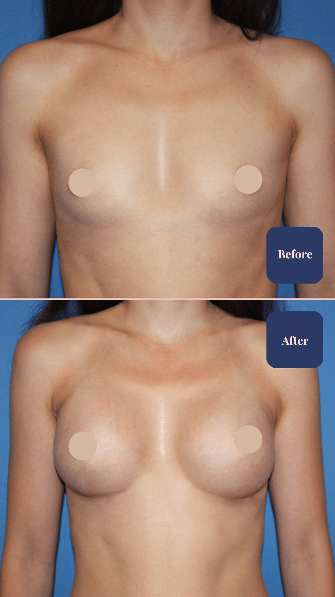 Before and after plastic surgery result