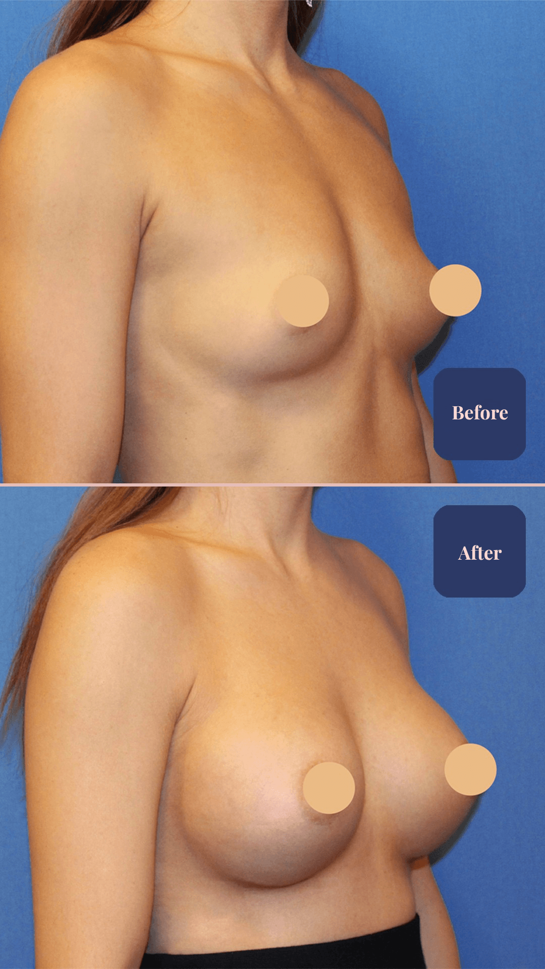 Before and after plastic surgery result
