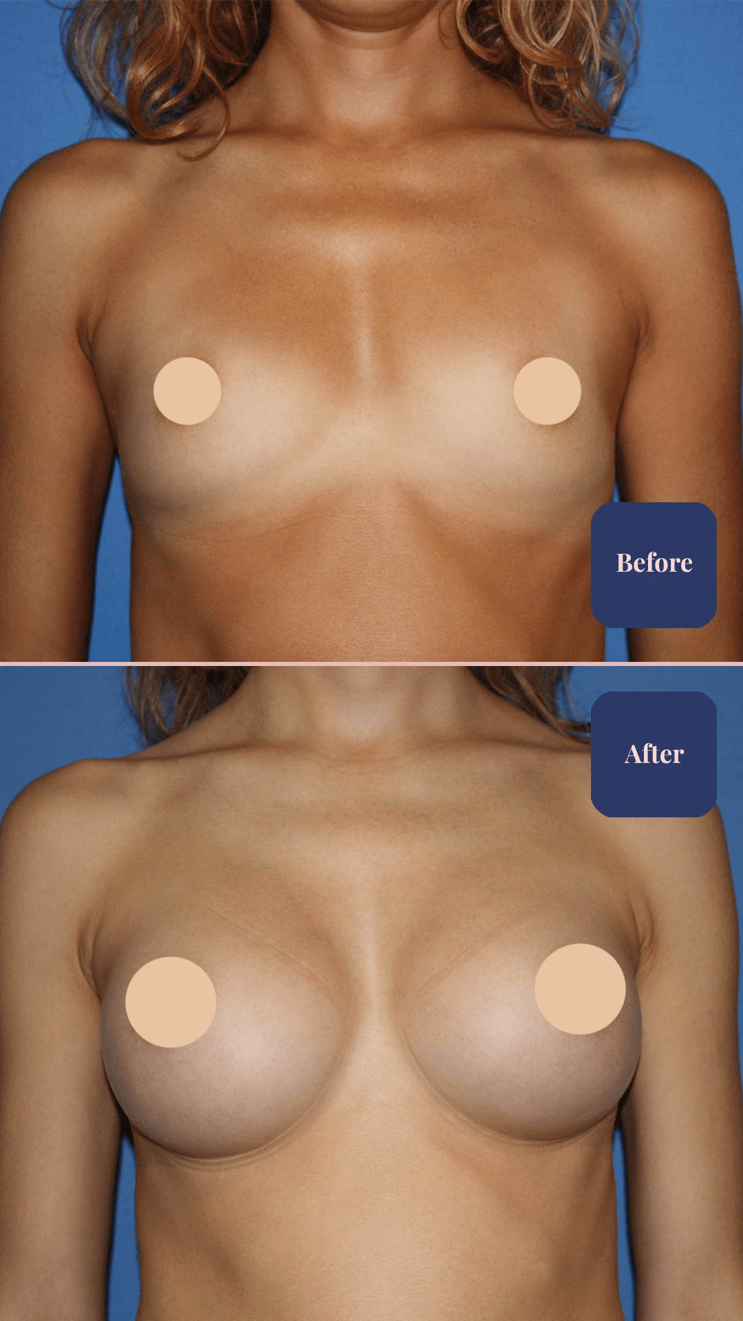 Before and after plastic surgery result