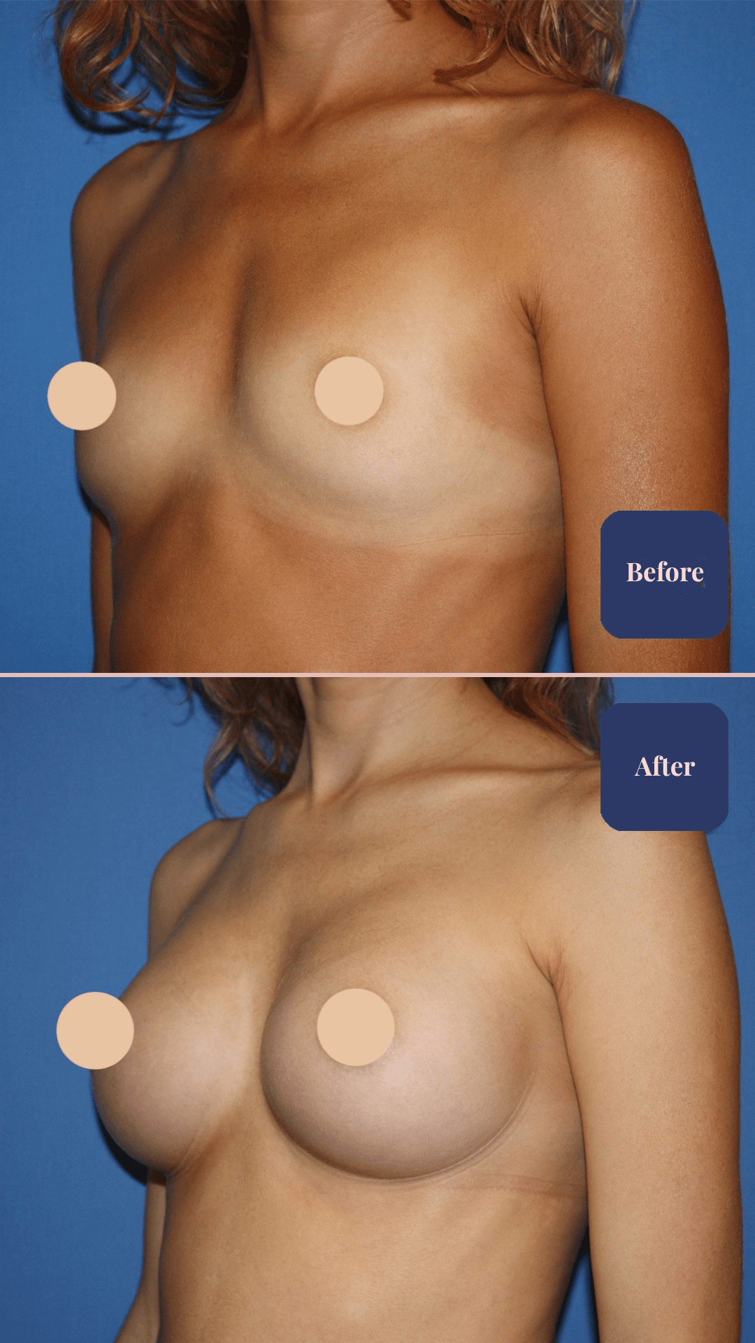 Before and after plastic surgery result