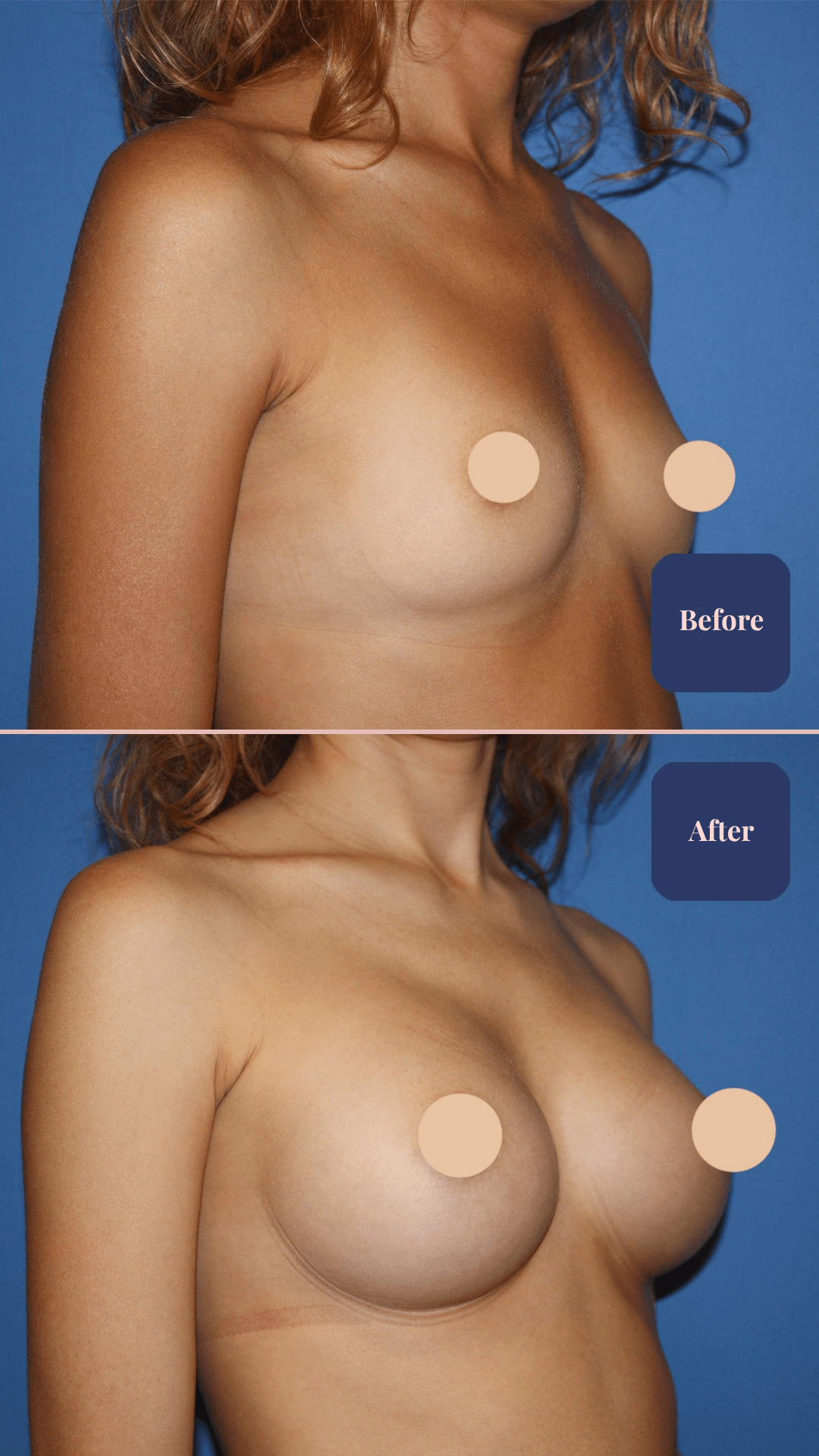 Before and after plastic surgery result