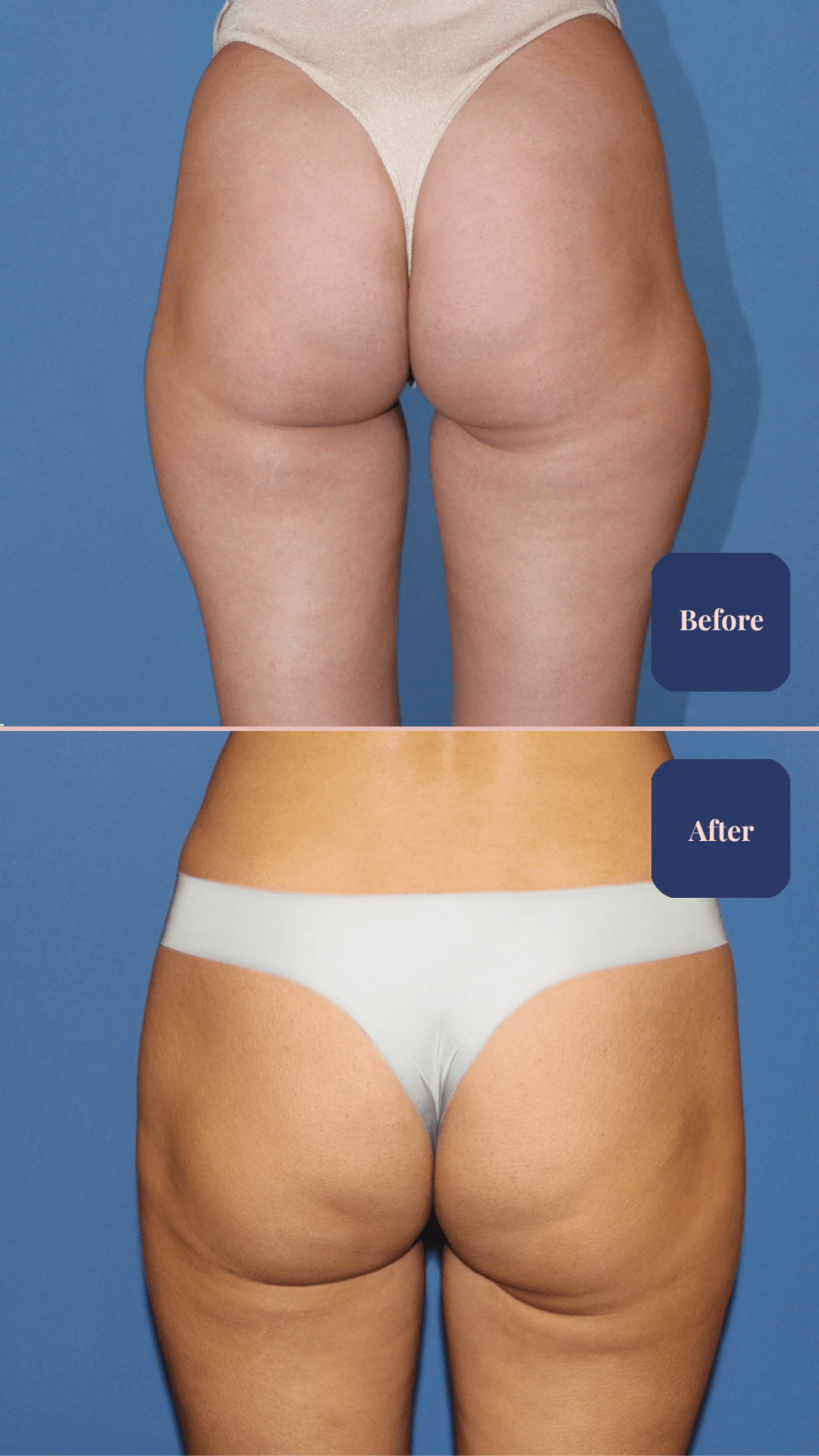 Before and after plastic surgery result