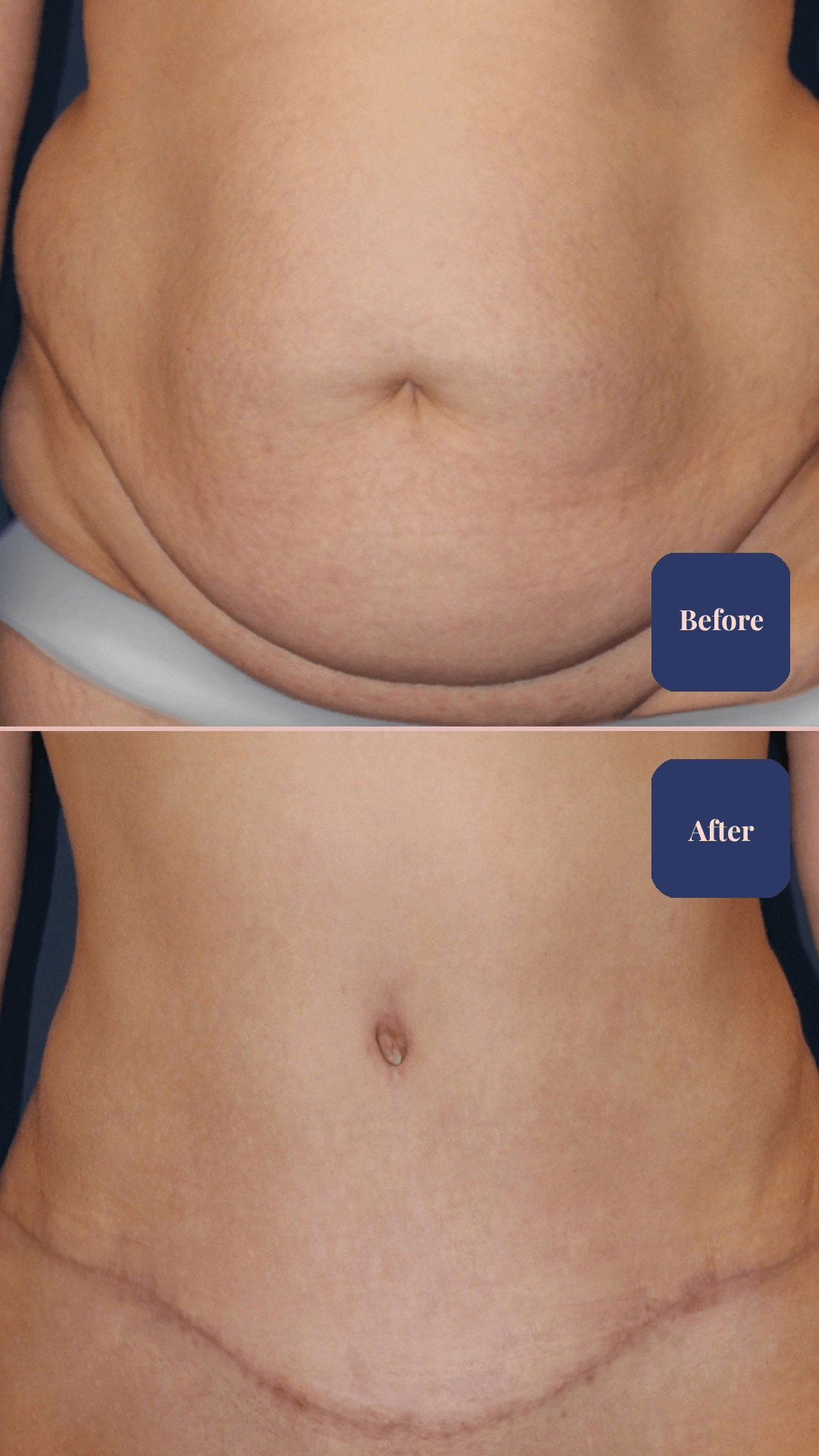 Before and after body surgery result