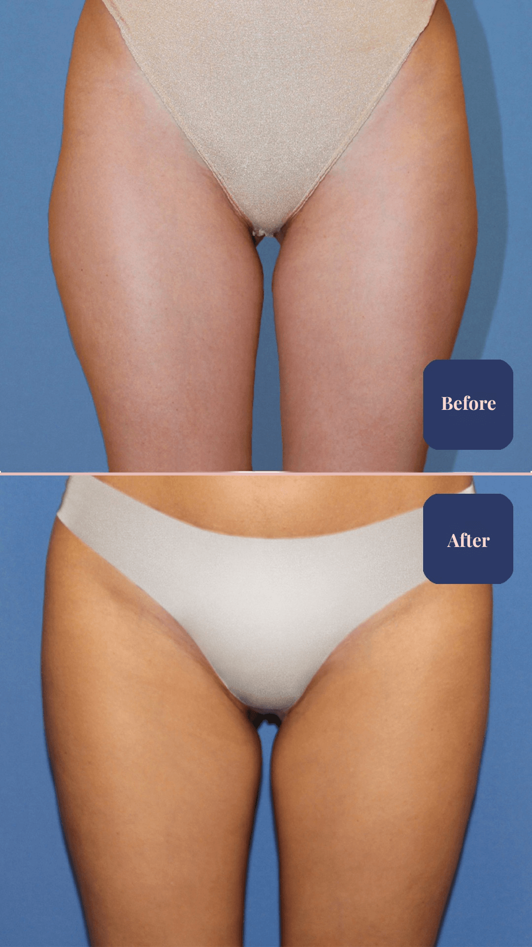 Before and after body surgery result