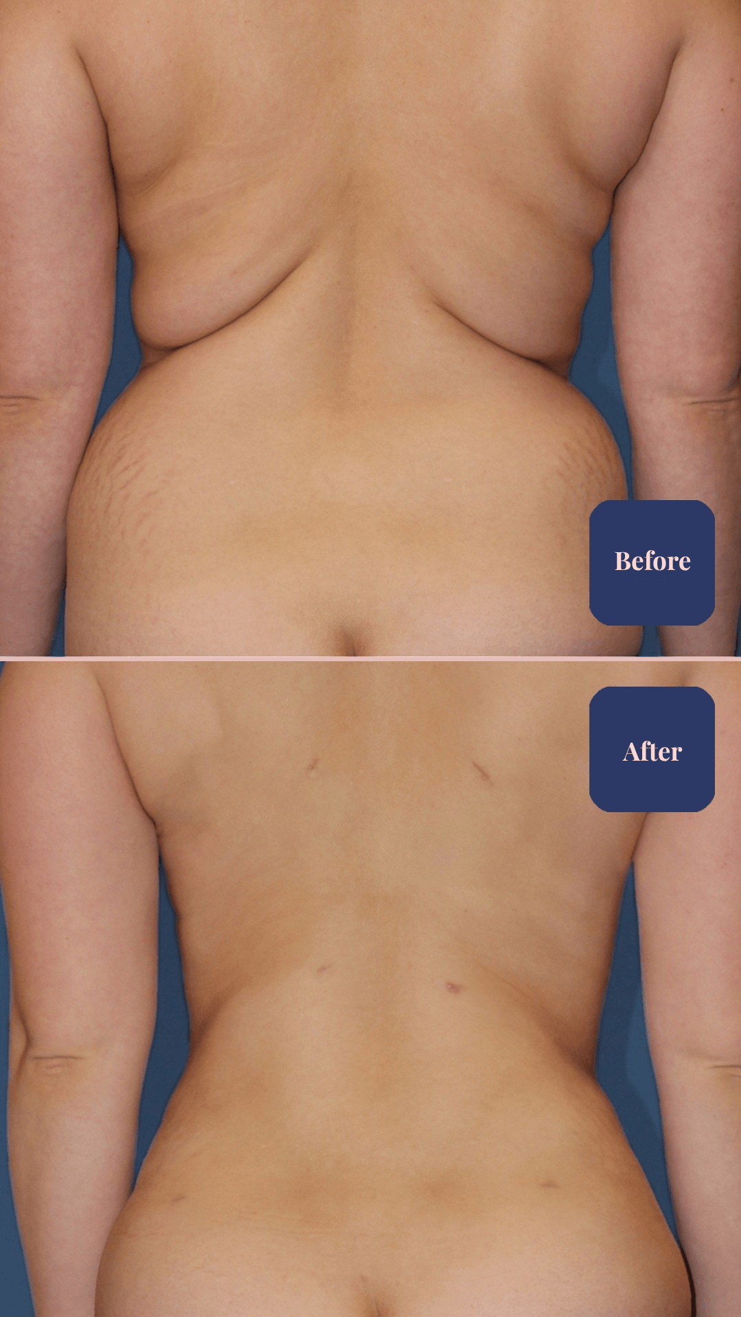Before and after body surgery result