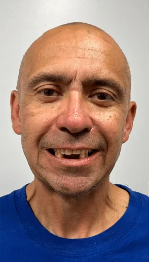 Patient with visible gaps in the upper front teeth during an initial smile evaluation