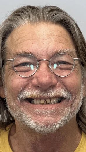 Man with visible missing and discolored teeth smiling during an initial dental evaluation while wearing round eyeglasses