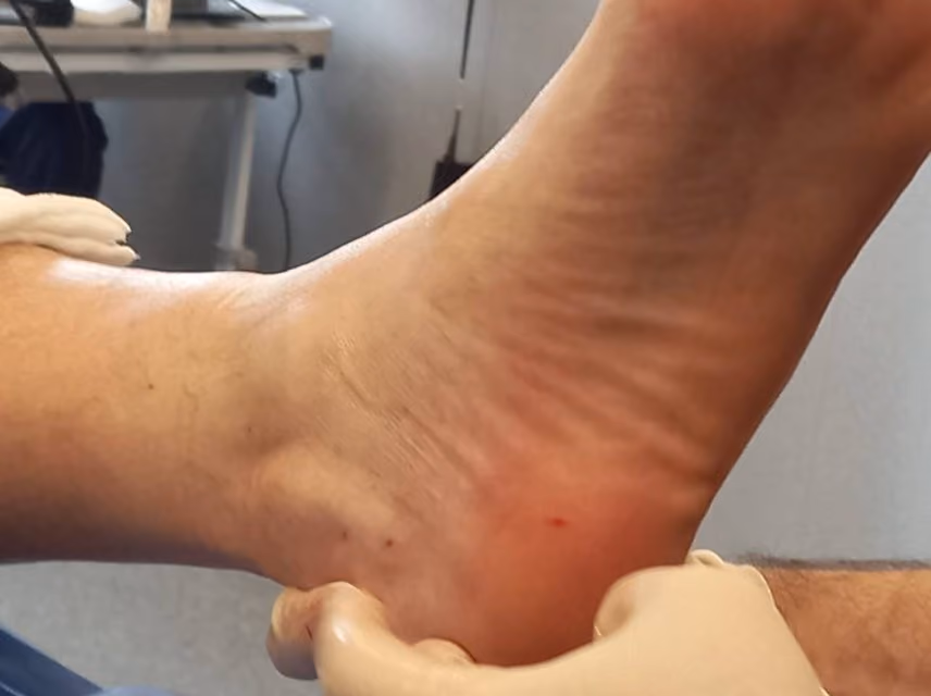Clinician in gloves examining a patient's heel during plantar fasciitis treatment at Nexsis BioHealth