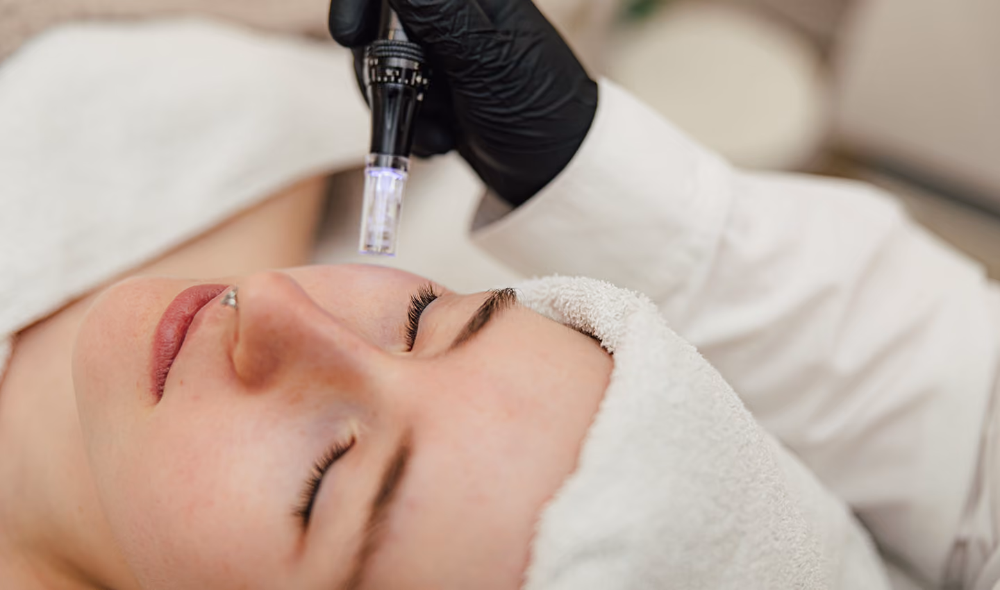 Person erhält Microneedling-Gesichtsbehandlung mit einem Handgerät von einer schwarz behandschuhten Hand.