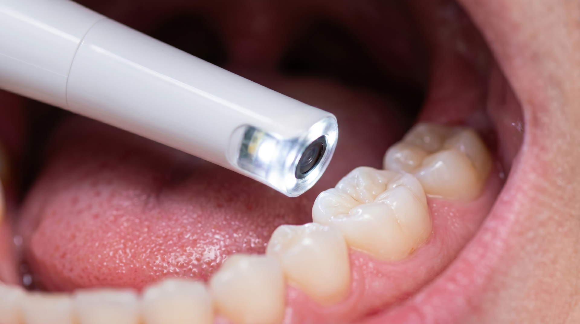 Intraoral dental camera inspecting the molars on the lower jaw inside a person's mouth.