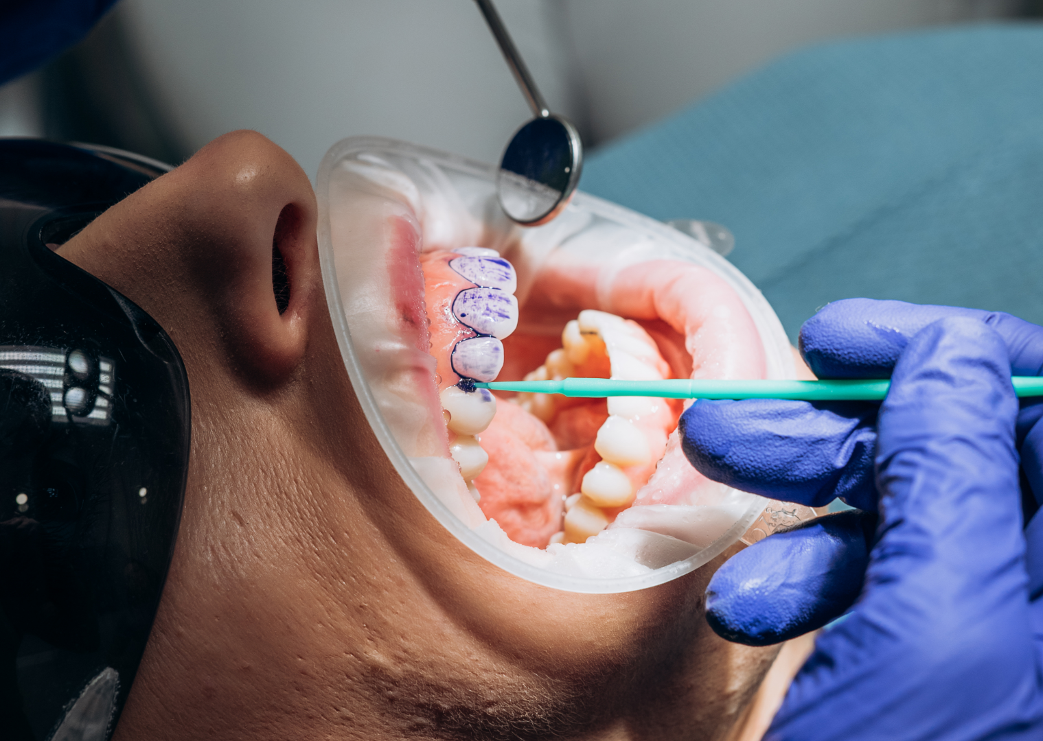 Dentist wearing purple gloves marking blue dental plaque on patient's upper teeth during exam.
