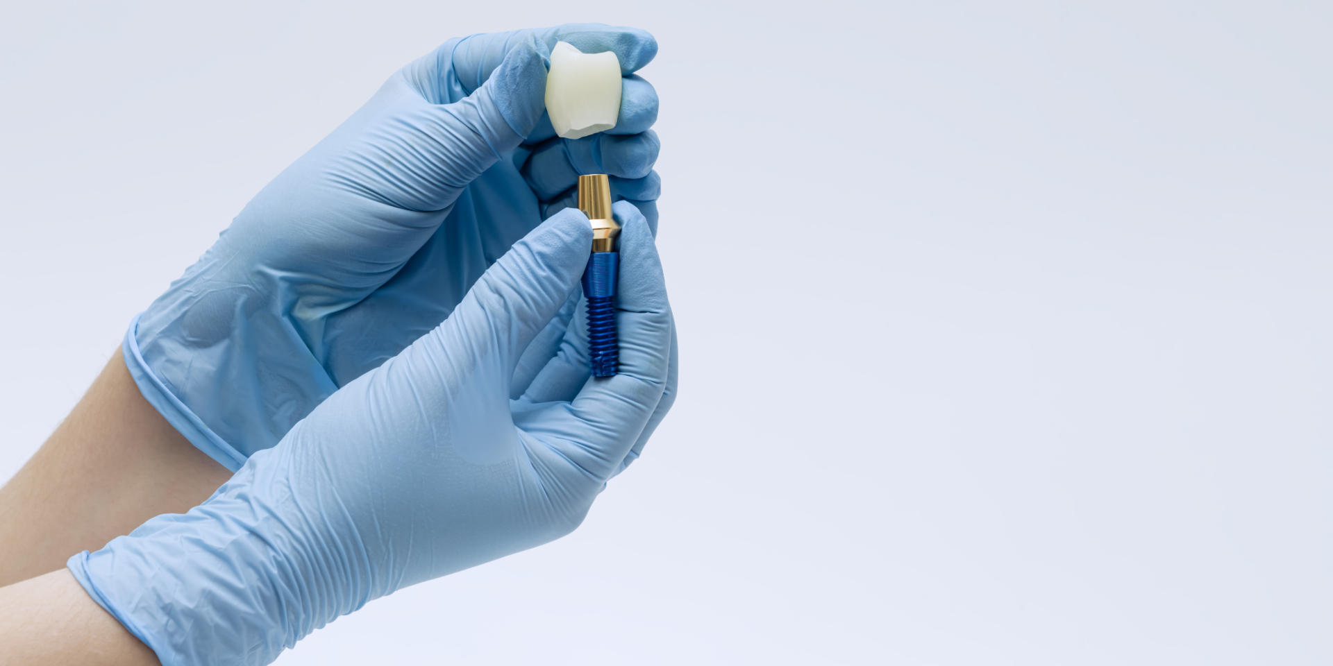 Hands in blue gloves holding a dental crown and an implant screw against a light background.