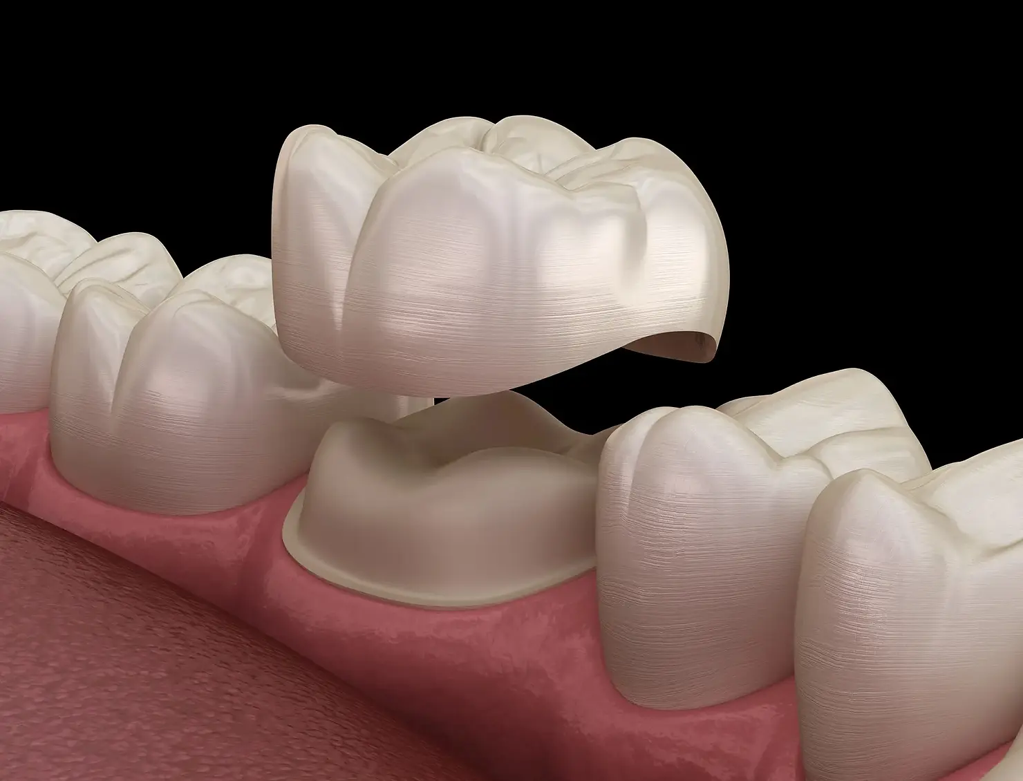 Dental Crown for Dental Implant Restoration Washington DC