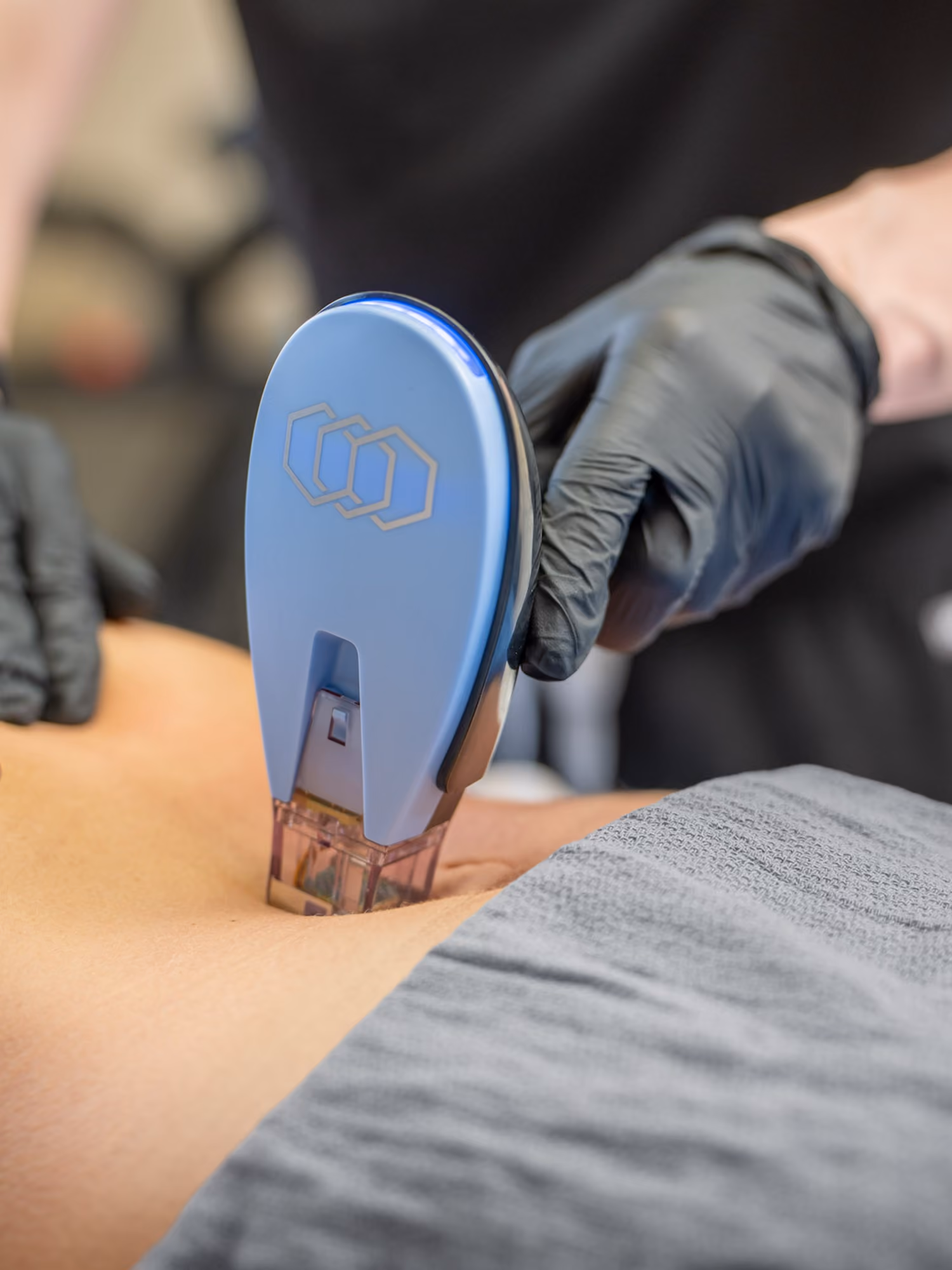Close-up of a hand wearing black glove using a blue handheld device on a person's abdomen.