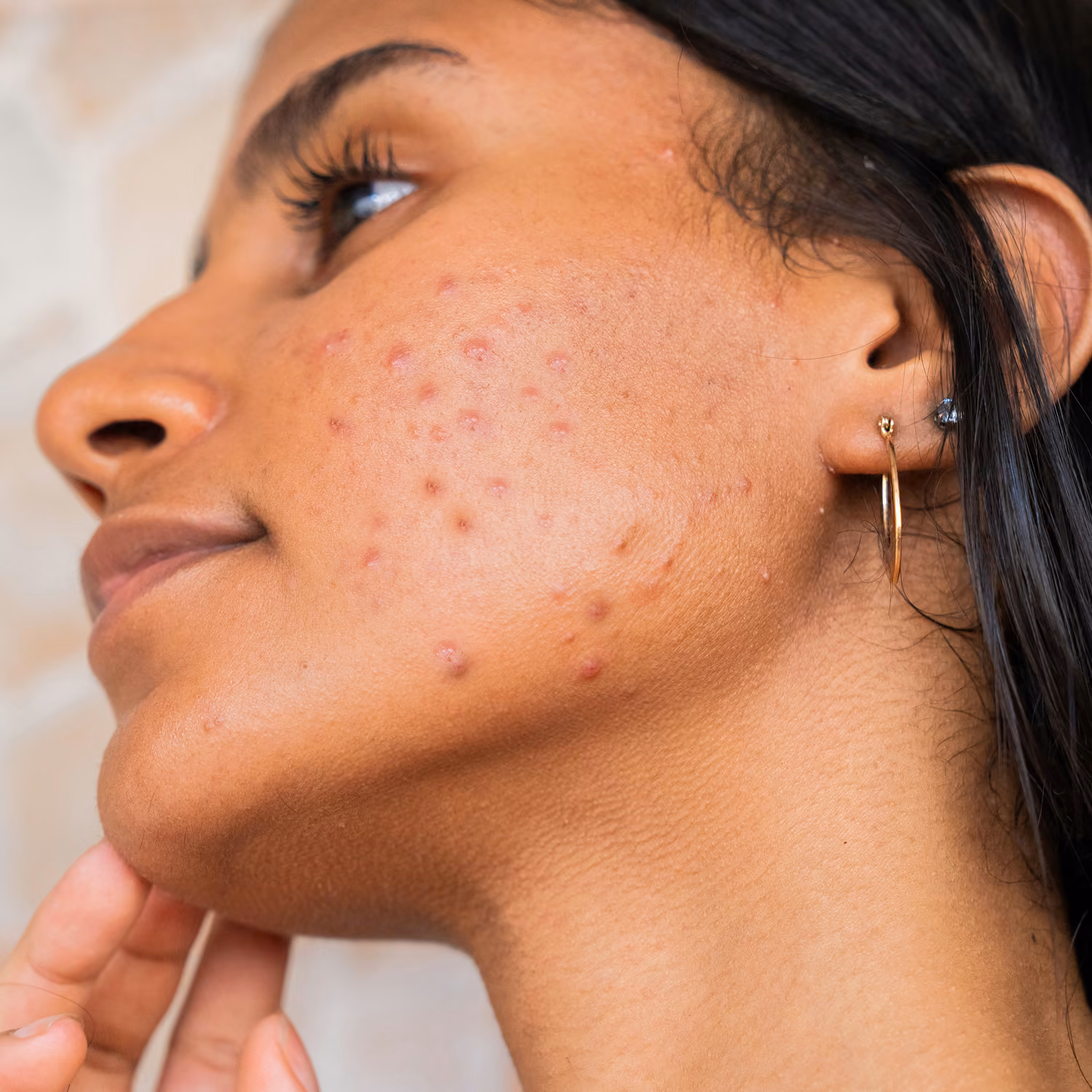 Close-up of a woman’s cheek with acne and blemishes, her hand lightly touching her jaw.
