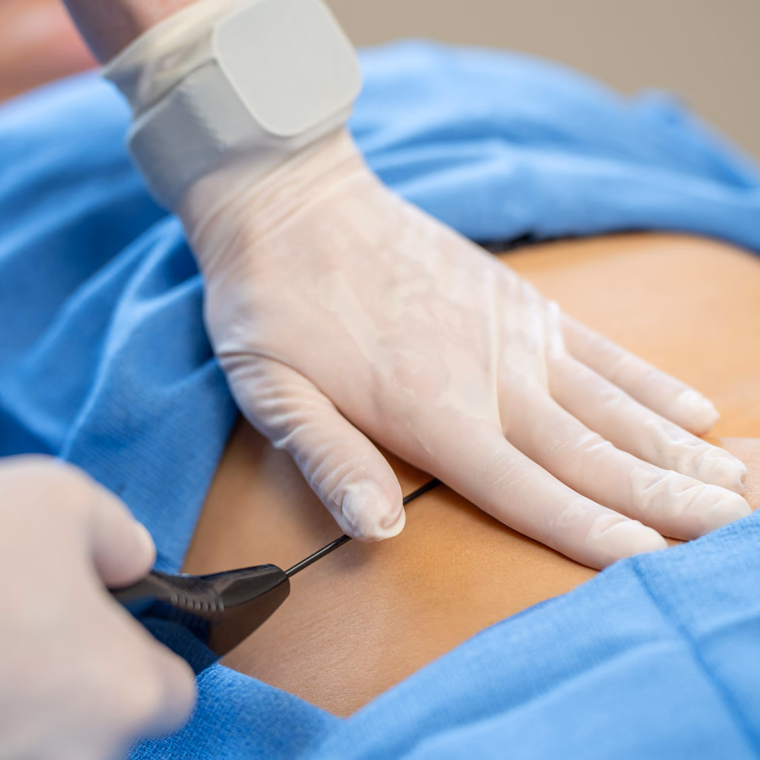 Medical professional with gloves using a device on a person's lower back over blue drape.