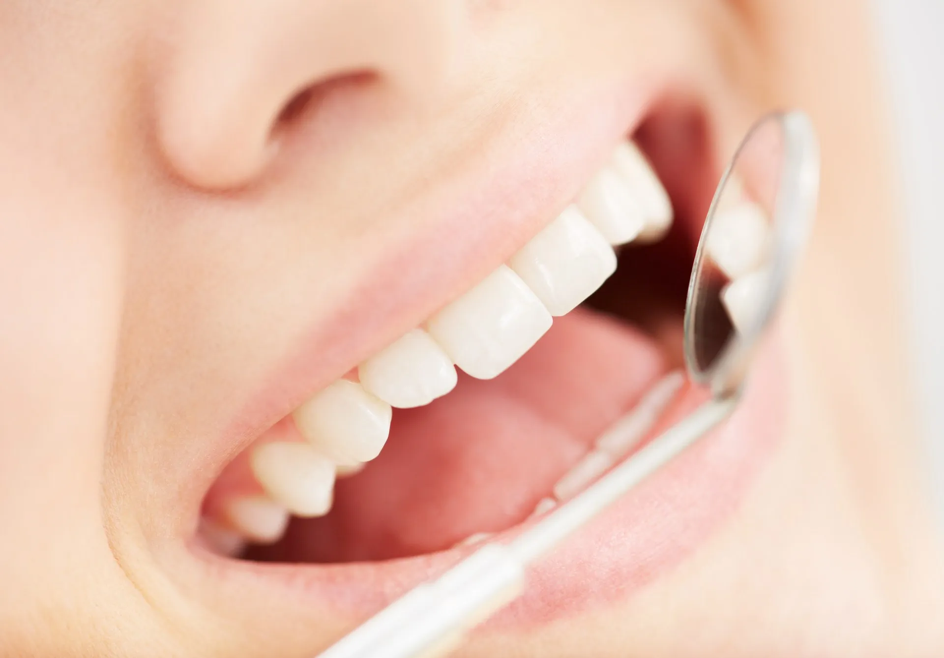 Close-up of a tooth-colored composite filling blending seamlessly with the natural tooth structure