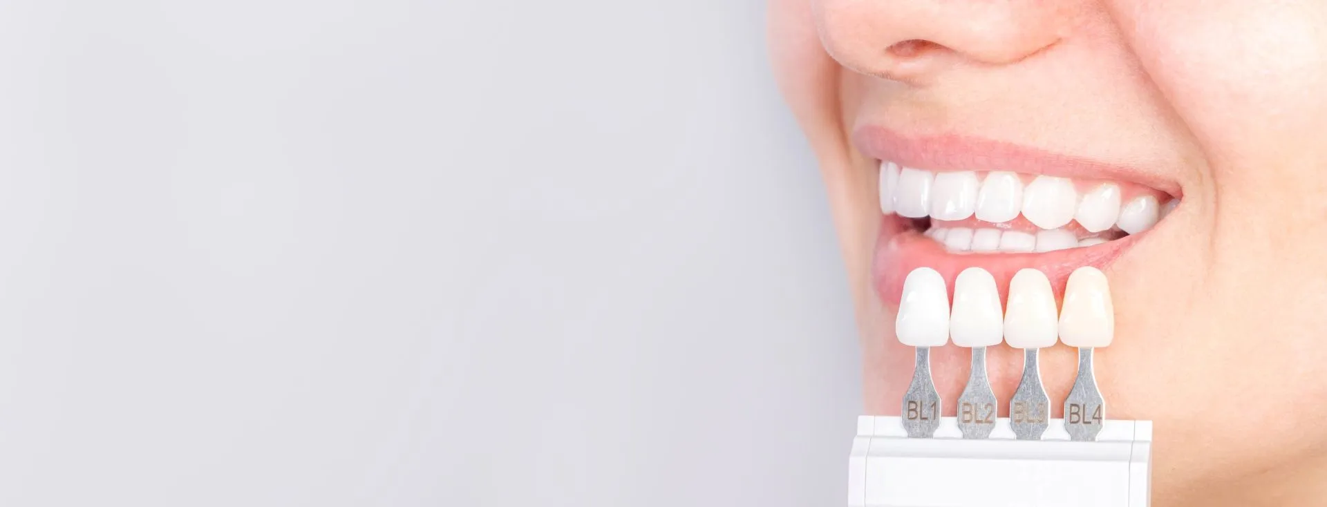 Before and after comparison of a patient's smile transformed with custom porcelain veneers at Nova Dental Care of Vienna