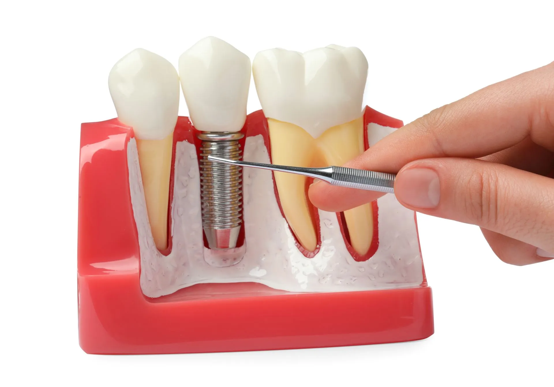 Dental model showing a full-arch implant-supported restoration replacing an entire row of missing teeth