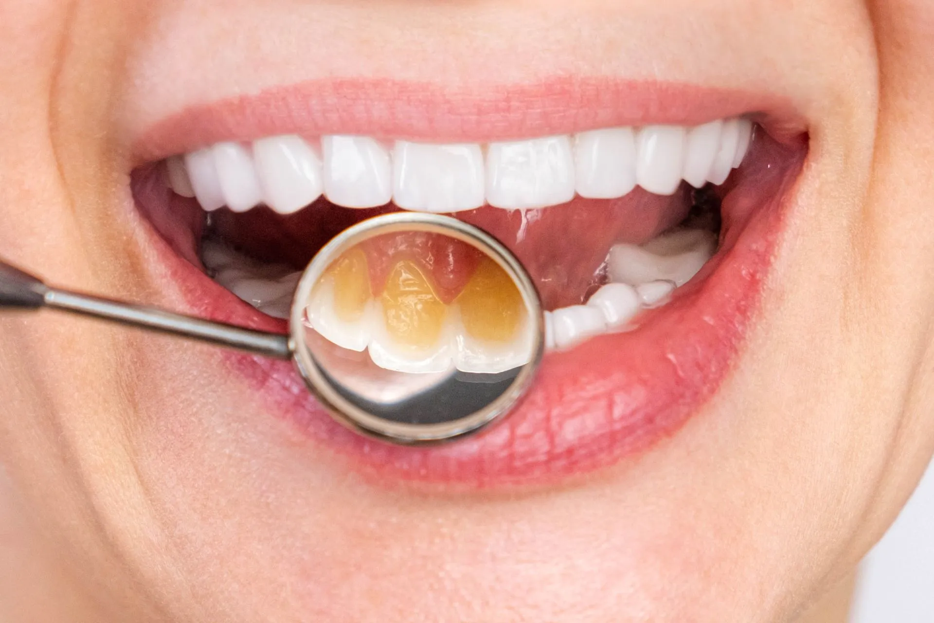 Before and after comparison showing a tooth restored with a natural-looking porcelain inlay