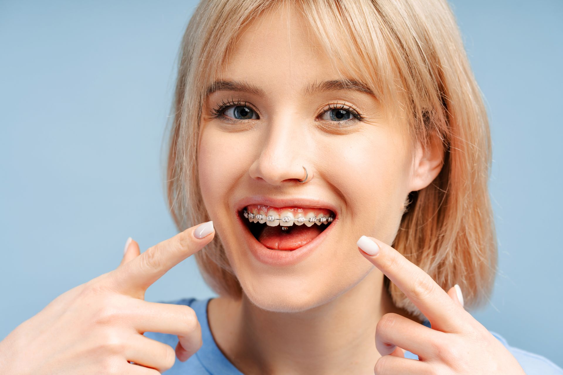 Teen patient smiling with traditional metal braces during orthodontic treatment at Nova Dental Care of Vienna