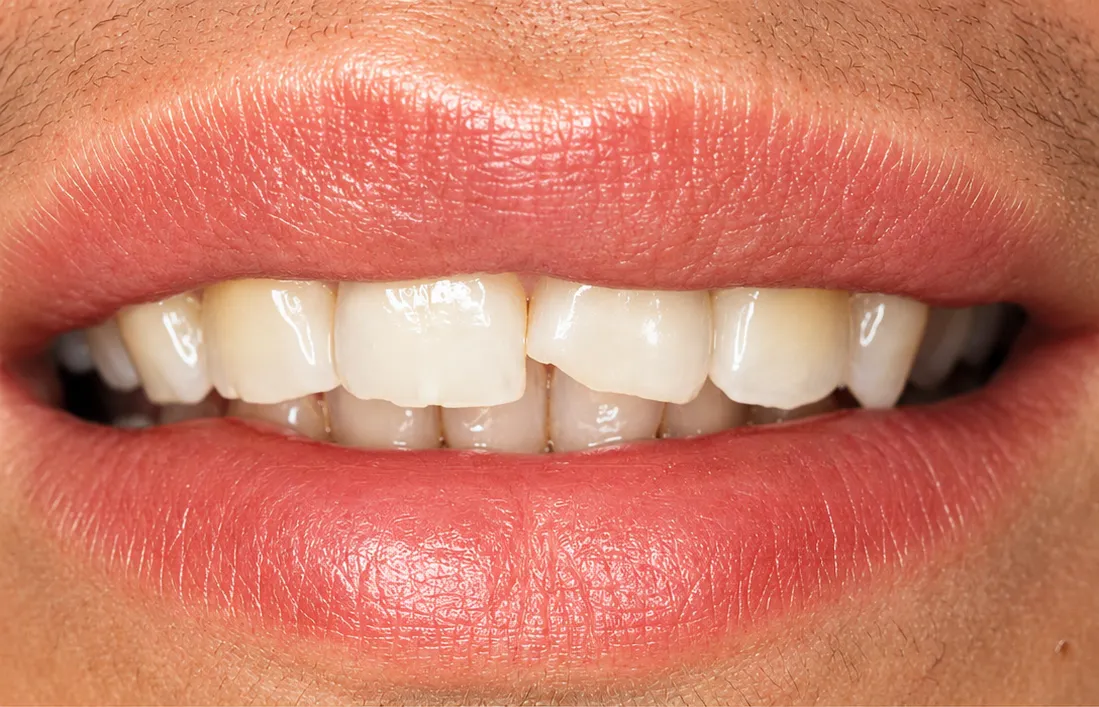 Before teeth whitening treatment — Nova Dental Care of Chantilly