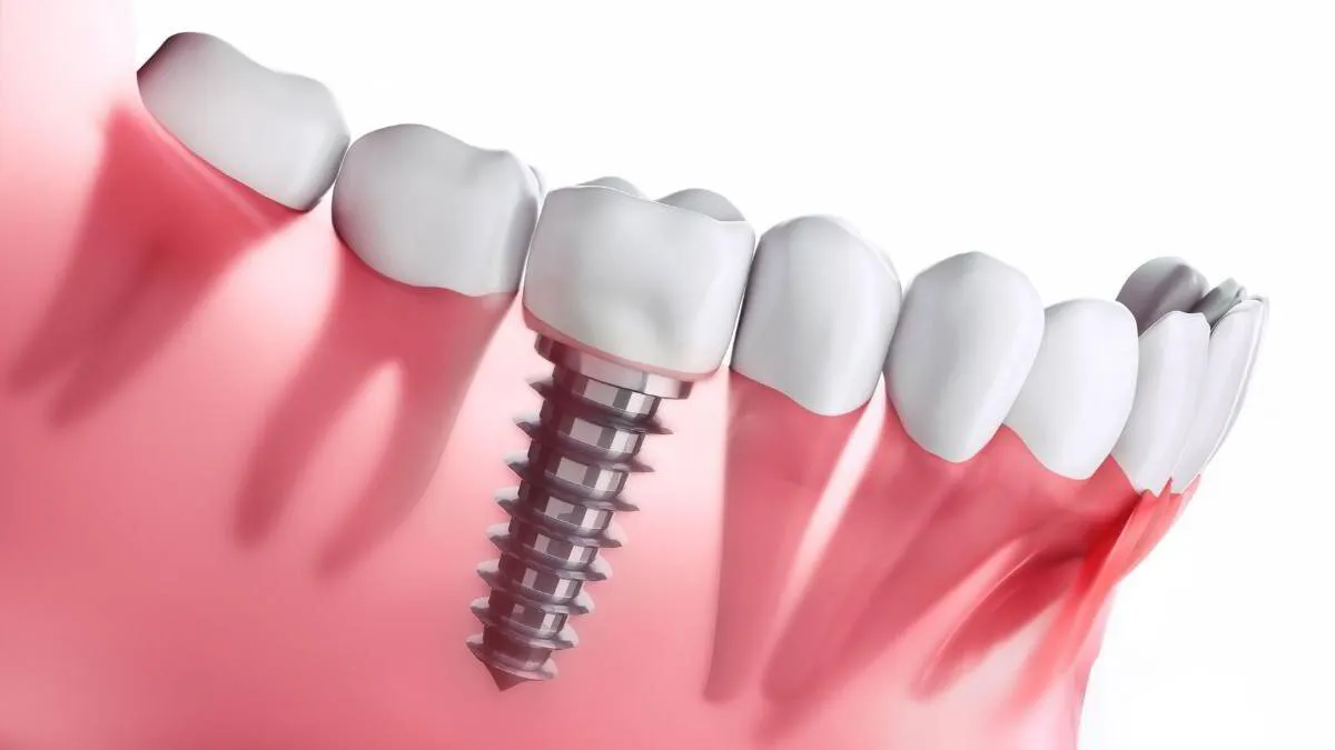 Dental team member showing a patient a model of implant supported teeth