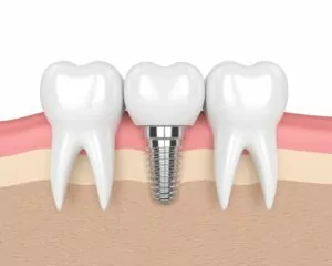 Dental implant cost consultation – Greene & Ratcliff Arlington TX