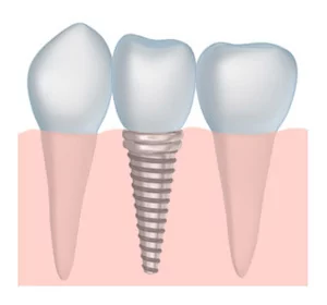 Final crown placed on implant – Greene & Ratcliff, Arlington TX