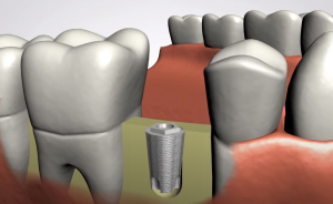 Dental implant placed in the jawbone – Greene & Ratcliff, Arlington TX