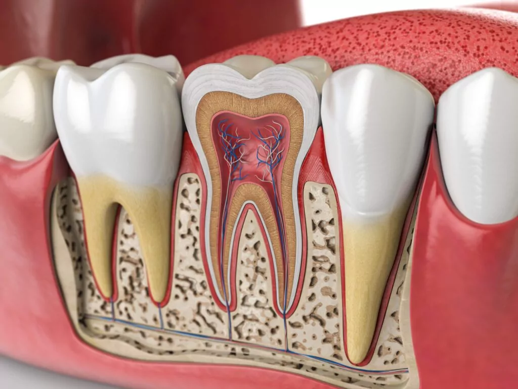 Infected tooth root system in need of a root canal